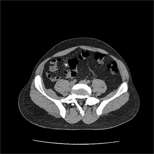 An axial computed tomography (CT) scan of the lower abdomen and pelvis. A distinct, hyperdense linear structure, representing a ventriculoperitoneal shunt (VPS) catheter, is identified within the abdominal cavity. The image demonstrates the catheter's intraluminal position within the sigmoid colon, following its migration from the intraparietal space.