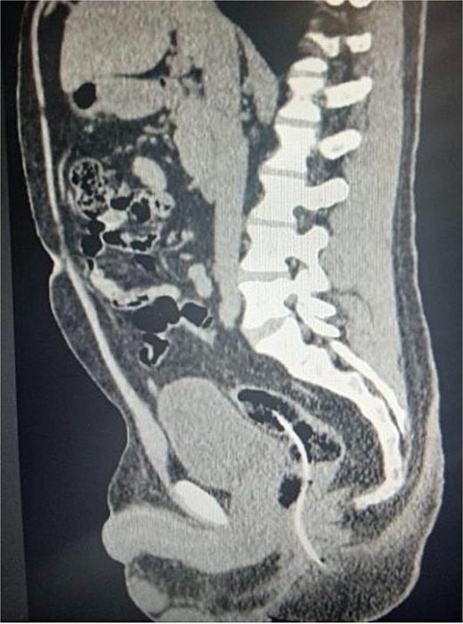 A sagittal computed tomography (CT) scan of the pelvic region. A hyperdense, tubular structure consistent with a ventriculoperitoneal shunt (VPS) catheter is observed following a descending path into the pelvis. The image clearly demonstrates the catheter's penetration into the intestinal loop, with a well-defined intraluminal course within the sigmoid colon. Surrounding pelvic anatomy, including the bladder and the sacrolumbar spine, is visualized in grayscale for clinical reference.