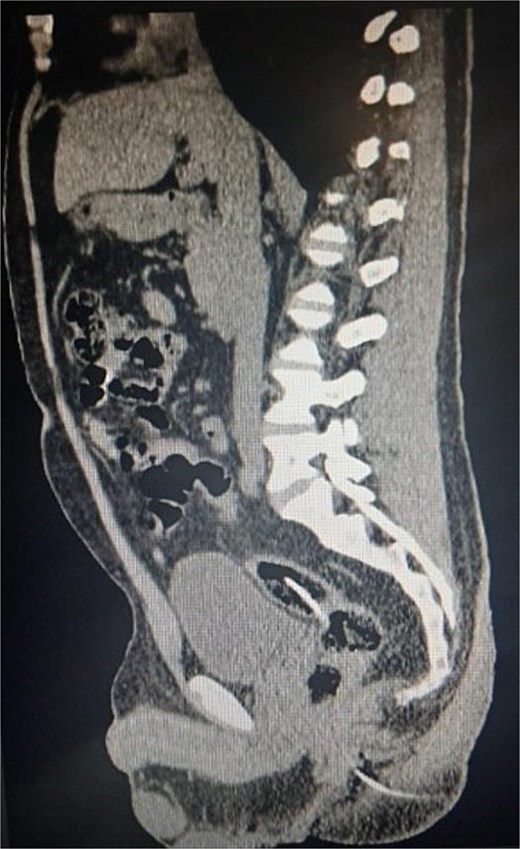 A sagittal computed tomography (CT) scan of the pelvic region. A continuous, hyperdense tubular structure, consistent with a ventriculoperitoneal shunt (VPS) catheter, is visualized traversing the sigmoid colon and rectum, and exiting through the anal canal. The image demonstrates the distal portion of the catheter protruding exteriorly from the anal orifice.