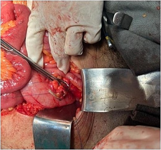 An intraoperative photograph during a laparotomy, demonstrating a segment of a ventriculoperitoneal shunt (VPS) catheter. A translucent, yellowish tubular structure is shown penetrating the wall of the sigmoid colon. The catheter has been isolated and secured with a surgical clamp to document the definitive surgical confirmation of colonic perforation resulting from shunt migration.