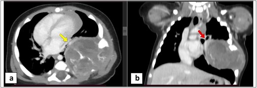 Two-panel contrast-enhanced CT of the chest in a 4-month-old male infant. Panel A (axial view) and Panel B (coronal view) demonstrate a large complex chest wall mass arising from the left sixth rib with both intrathoracic and extrathoracic components, multilocular cystic changes, calcifications, and enhancing soft tissue. The intrathoracic component causes left lung collapse, extends toward the left hilum and pulmonary veins without vascular encasement, and is associated with mild rightward mediastinal shift. Left paravertebral extension is present without intraspinal involvement. Arrows indicate the left hilum and pulmonary veins.