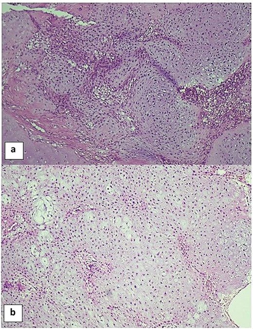 Two-panel histopathological image of chondromesenchymal hamartoma of the chest wall. Panel A and Panel B show solid areas of the lesion at low magnification (haematoxylin and eosin, times ten), composed of lobules of hyaline cartilage surrounded by intervening benign spindle cells within a mesenchymal stroma.