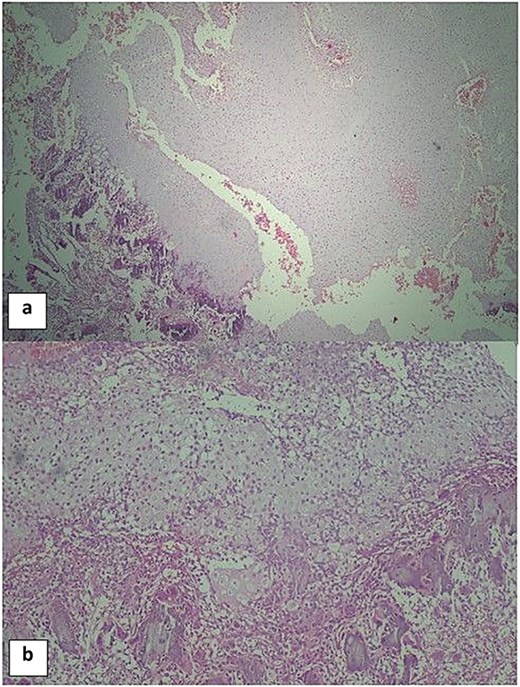 Two-panel histopathological image of chondromesenchymal hamartoma of the chest wall. Panel A and Panel B show cystic areas of the lesion at low magnification (haematoxylin and eosin, times ten), demonstrating aneurysmal bone cyst-like features including haemorrhage, osteoclast-type giant cells, and foci of calcification.