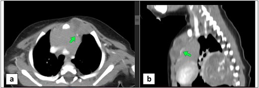 Two-panel contrast-enhanced CT of the chest in a 4-month-old male infant. Panel A (axial view) and Panel B (sagittal view) demonstrate a multilobulated anterior parasternal chest wall lesion at the level of the first and second costal cartilages, showing multilocular cystic changes and enhancing soft tissue components. The lesion abuts the thymus gland and displaces the left internal mammary vessels, indicated by an arrow.