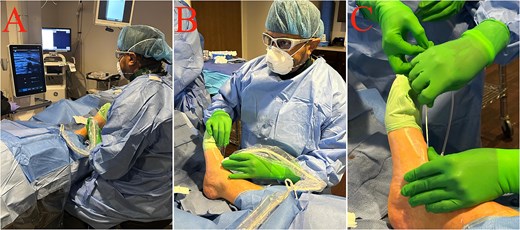 Ultrasound-guided pedal arterial access in three steps. Panel A shows the patient supine with the ipsilateral foot prepared and draped, and the ultrasound system positioned for real-time guidance. Panel B shows ultrasound-guided puncture of a pedal artery on the dorsum of the foot using an oblique needle approach with continuous needle-tip visualization. Panel C shows guidewire advancement through the access needle after successful arterial puncture.