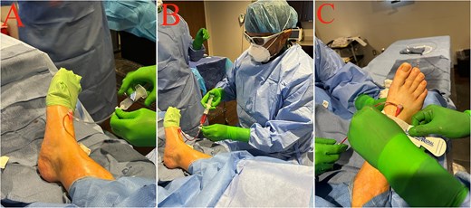 Pedal sheath setup and confirmation in three steps. Panel A shows a short pedal sheath secured on the dorsum of the foot and connected to extension tubing and a three-way stopcock. Panel B shows aspiration and back-bleeding through the sheath and tubing, confirming intraluminal placement before angiography. Panel C shows a hemostatic compression device applied over the pedal access region to stabilize the sheath and support hemostasis.