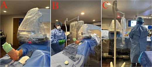 Fluoroscopy setup after pedal access in three views. Panel A shows the covered C-arm positioned over the draped foot after pedal access, with extension tubing maintained for flushes and contrast injection. Panel B shows the procedure-room setup, including the patient under sterile drapes, the covered C-arm, and protective shielding during fluoroscopy. Panel C shows the operator working within the sterile field while viewing imaging monitors during the fluoroscopic phase of the procedure.