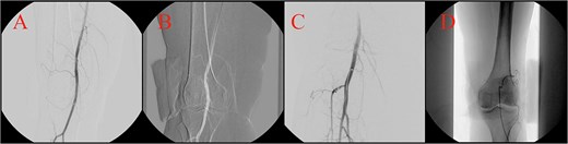 Angiographic navigation from pedal access to selective genicular catheterization in four steps. Panel A shows an initial retrograde angiogram through the pedal sheath demonstrating the arterial roadmap. Panel B shows roadmap-guided wire advancement from the pedal access site toward the distal superficial femoral and popliteal segment. Panel C shows the mini-RIM catheter positioned from the pedal approach to provide support for selective branch cannulation. Panel D shows the microcatheter positioned distally within the target genicular artery before selective angiography and embolization.