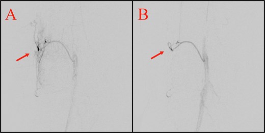 Selective genicular angiograms before and after embolization. Panel A shows a pre-embolization angiogram of the superior lateral genicular artery territory with abnormal hypervascularity or blush marked by an arrow. Panel B shows a post-embolization angiogram from a treated genicular branch with marked reduction or resolution of the hypervascularity, while arterial patency is preserved.