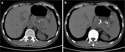 Non-contrast axial abdominal CT scan showing two round cystic low-density lesions with peripheral calcification in the left upper abdomen, adjacent to the pancreatic tail. The larger lesion measures 52 mm x 44 mm.