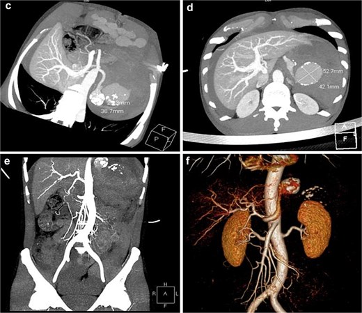 Emergency contrast-enhanced CT angiography showing two round nodular high-density lesions in the distal splenic artery measuring 36.7 mm x 27.3 mm and 42 mm x 52.7 mm, with active extravasation of contrast material and surrounding patchy opacities consistent with acute hemoperitoneum.