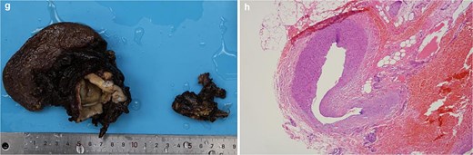 Pathological findings: Gross specimen showing dark, irregular aneurysmal tissue with internal cystic spaces measuring 5-7 cm; photomicrograph (H and E stain) demonstrating thinned arterial wall with focal disruption and adjacent organizing hematoma.