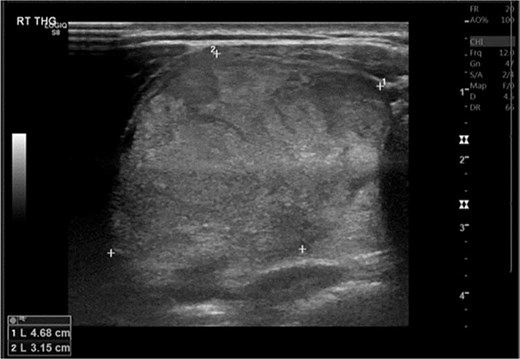 Ultrasound image of the thyroid showing an enlarged right thyroid lobe.