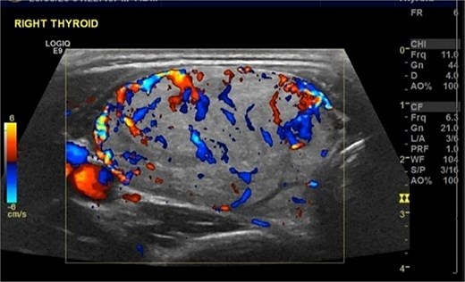 Color Doppler ultrasound of the enlarged right thyroid lobe showing multiple oval isoechoic solid nodules with internal and perinodular vascularity. The largest nodule measures approximately 40 x 25 mm.