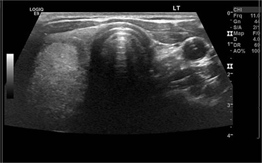 Thyroid ultrasound demonstrating absence of the left thyroid lobe, with visualization of the right thyroid lobe.