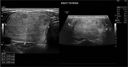 Ultrasound image of the right thyroid lobe showing measurements approximately 38 x 27 x 48 mm.
