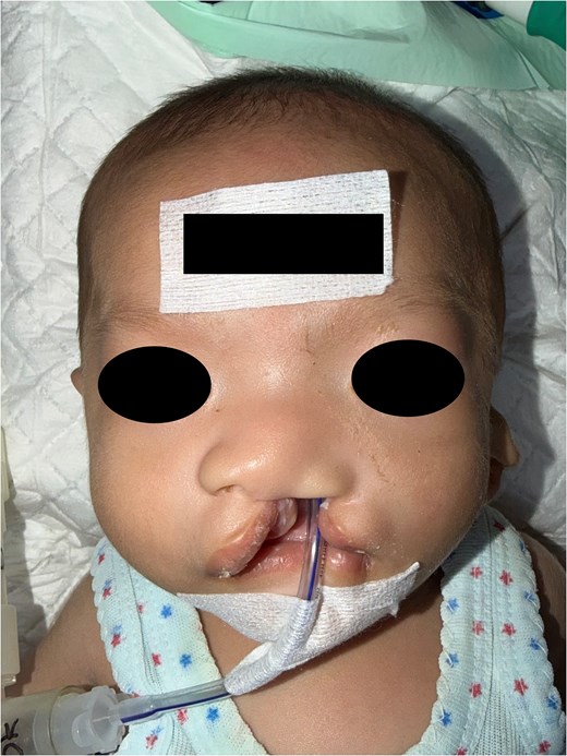 A close-up, preoperative frontal photograph of an infant's face. The infant has a complete cleft lip on the left side, extending up into the nostril. An endotracheal or feeding tube is secured across the lower face with medical tape. The infant's eyes and forehead are obscured by grey blocks for privacy.