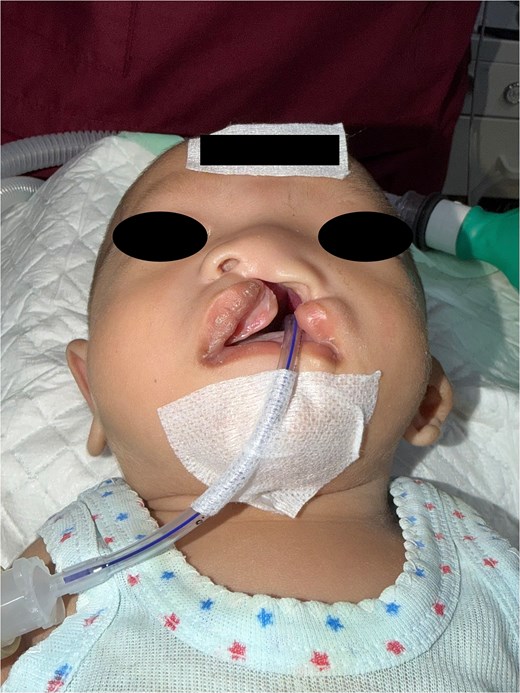 A preoperative, basal (submental) view photograph of an infant lying down. The perspective looks upward toward the nose and mouth, showing a unilateral cleft deformity affecting the upper lip and alveolus, along with flattening and asymmetry of the left nasal ala. A medical tube is secured to the chin with gauze and tape, extending into the mouth.