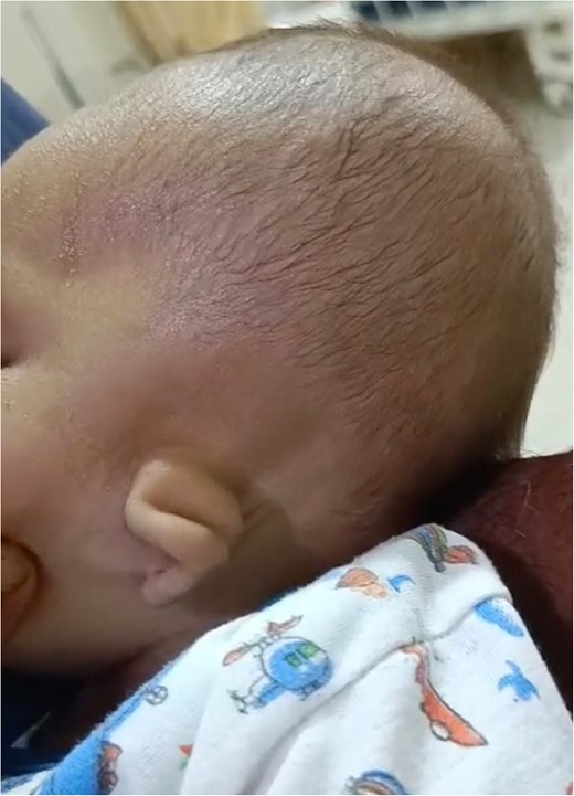 A close-up, lateral (side-profile) photograph of an infant's head focusing on a malformed left ear. The external ear is significantly smaller than normal, exhibiting a vertically oriented, curved, sausage-like remnant of cartilage and tissue lacking a fully developed pinna or lobule.