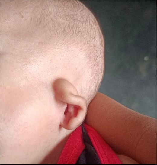 A close-up, side-profile photograph focusing on the left ear (auricle) of an infant. The image clearly shows the external structures of the ear and the opening of the patent external auditory canal.