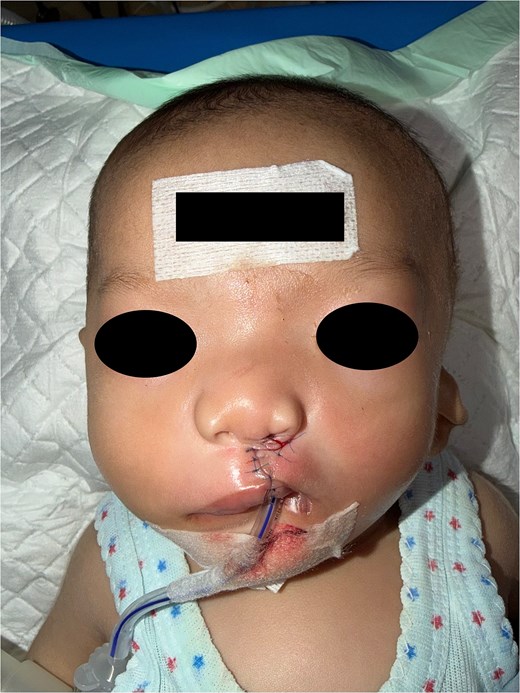 An early postoperative frontal photograph of the infant's face. The left upper lip defect has been surgically repaired, showing a neat line of blue sutures extending from the left nostril floor down to the vermilion border.