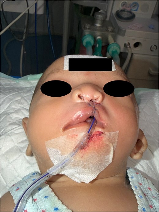 An early postoperative basal (submental) view photograph looking upward at the infant's face from below the chin. The upper lip displays surgical reconstruction with visible blue sutures aligning the cleft defect. The left nasal ala shows improved rounding, vertical height, and symmetry compared to preoperative images.
