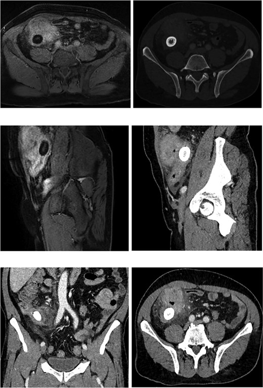 CT and MRI images of the terminal ileum showing progressive circumferential bowel wall thickening with an associated mass lesion and a contained perforation. MRI additionally demonstrates an intraluminal enterolith within the affected bowel segment.