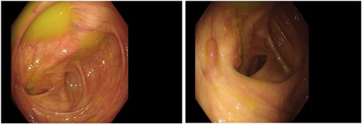 Colonoscopic image demonstrating severe stenosis of the ileocecal region with marked luminal narrowing. The endoscope could not be advanced through the stricture, and an obstructing lesion suspicious for underlying pathology is visible at the site of narrowing.