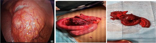 Intraoperative photograph showing a large mass involving the terminal ileum. Dense inflammatory adhesions are present around the lesion, with surrounding bowel loops and adjacent tissues adherent to the affected segment.