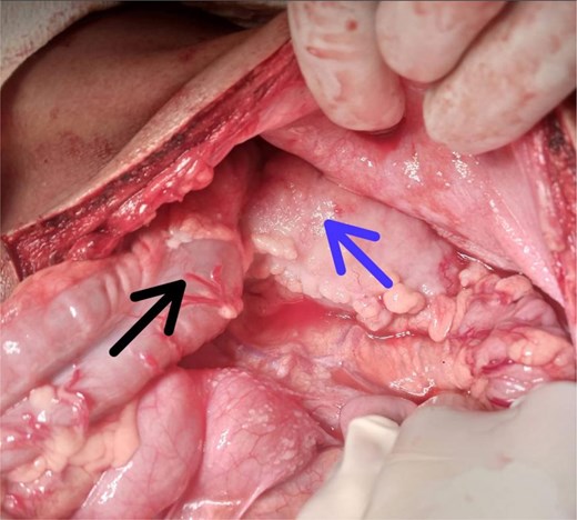Intraoperative view during exploratory laparotomy showing the transverse colon (black solid arrow) and the mass (blue dotted arrow) consistent with adenocarcinoma involving the colon in a pediatric patient undergoing segmental resection.