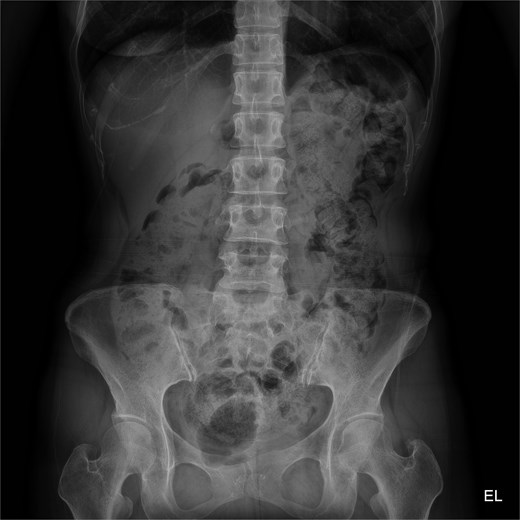 Abdominal radiograph showing diffuse colonic fecal loading on admission.
