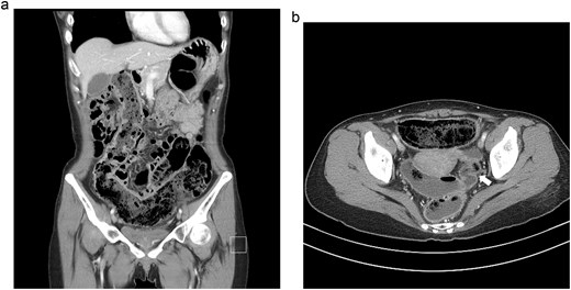 CT images showing a proximal sigmoid fecaloma with upstream fecal loading and acute angulation proximal to an intact staple line.