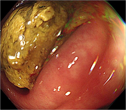 Endoscopic image showing hard impacted stool in the proximal sigmoid colon.