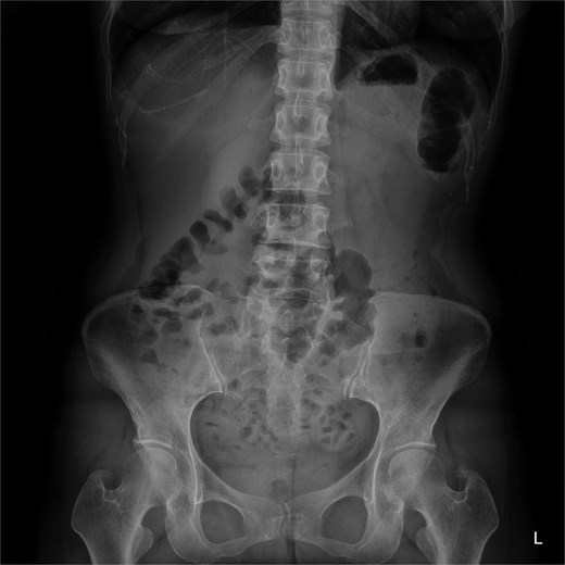 Follow-up abdominal radiograph showing resolution of fecal loading after PEG irrigation.