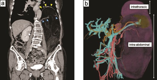 Contrast-enhanced computed tomography and three-dimensional reconstructed images show a large left retroperitoneal tumor extending into the left thoracic cavity through a diaphragmatic defect. The diaphragm appears thinned and stretched by the tumor, suggesting chronic mechanical stress.