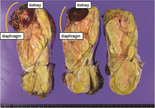 Intraoperative images show the diaphragmatic defect after resection of the retroperitoneal tumor and the surrounding diaphragm. The images demonstrate the size and location of the defect requiring surgical repair.