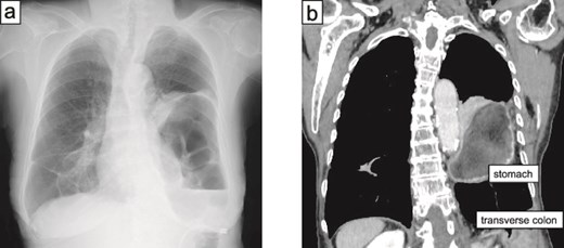 Postoperative computed tomography images show recurrence of the diaphragmatic hernia, with abdominal contents herniating into the left thoracic cavity through the repaired diaphragmatic defect.