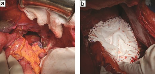 Postoperative computed tomography images after mesh repair show no recurrence of the diaphragmatic hernia. The repaired left diaphragm is maintained without protrusion of abdominal contents into the thoracic cavity.