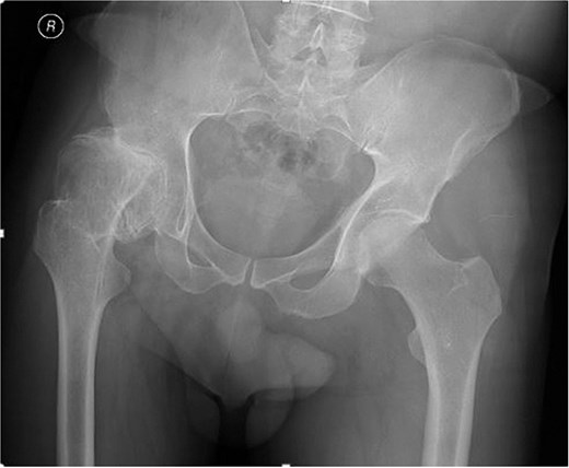 Preoperative anteroposterior pelvic radiograph showing advanced dysplastic osteoarthritis of the affected hip, with altered acetabular morphology and reduced joint space.