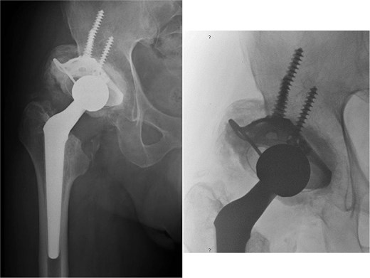 1-year follow-up anteroposterior pelvic radiograph showing total hip arthroplasty with a roof reinforcement ring and cemented acetabular cup, with superolateral acetabular reconstruction using morselised femoral head autograft.