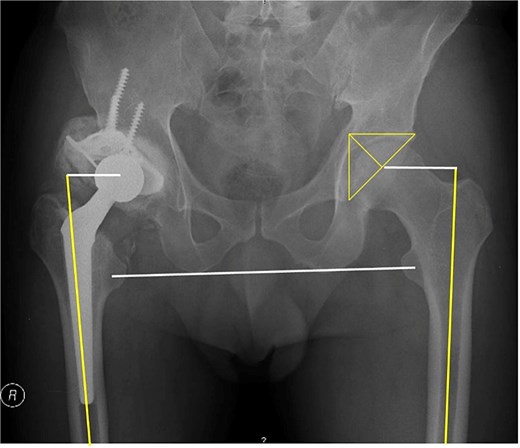 5-year follow-up anteroposterior pelvic radiograph showing total hip arthroplasty with a roof reinforcement ring and cemented acetabular cup, demonstrating progressive incorporation of the superolateral morselised femoral head autograft and maintained implant position.