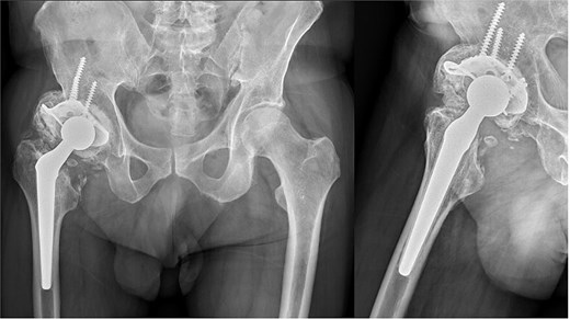 16-year follow-up anteroposterior and lateral radiographs showing total hip arthroplasty with a roof reinforcement ring and cemented acetabular cup. The morselised femoral head autograft appears incorporated, with no signs of implant instability or loosening, despite moderate acetabular wear and mature heterotopic bone.