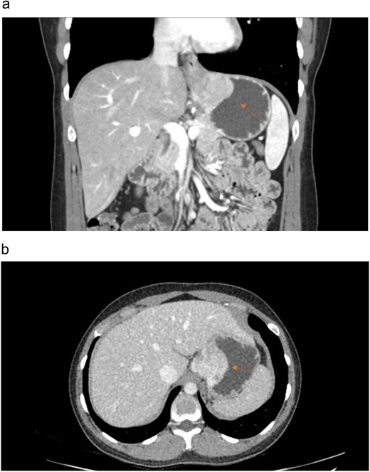 (a) CT scan in coronal view demonstrating a mass at the gastro-oesophageal junction. (b) CT scan in axial view demonstrating a mass at the gastro-oesophageal junction.