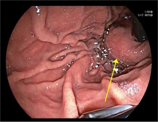Image taken during gastroscopy demonstrating a gastric mass at the gastro-oesophageal junction.