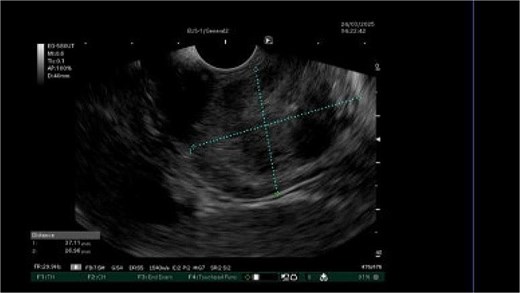 Image taken during EUS demonstrating a gastric mass at the gastro-oesophageal junction.