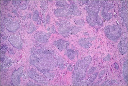 Histopathological image at ×2 magnification demonstrating prominent lymphoid aggregates within fibrotic gastric wall tissue.