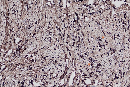 Histopathological image at ×20 magnification demonstrating IgG-positive plasma cells stained dark brown against a light brown background.