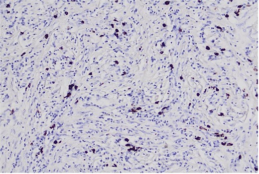 Histopathological image at ×20 magnification demonstrating IgG4-positive plasma cells stained dark brown against a light blue background; IgG4-positive cells comprise ~25% of IgG-positive plasma cells.