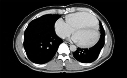 Preoperative contrast-enhanced computed tomography demonstrates the right ventricle positioned immediately beneath the sternum. This anatomical finding indicates a high risk of cardiac injury during repeat median sternotomy and supports the use of a left anterior mini-thoracotomy approach.