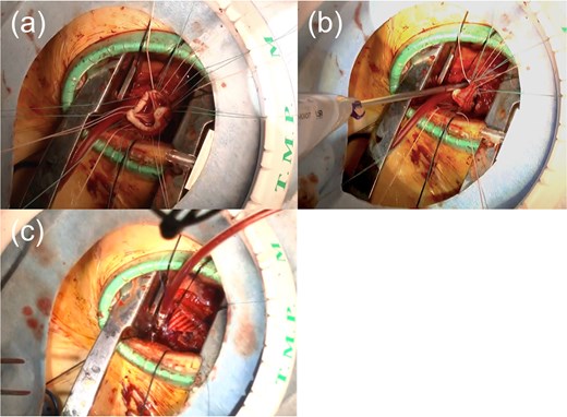 Intraoperative photographs demonstrating minimally invasive pulmonary valve replacement through a left anterior mini-thoracotomy. Panel (a) shows surgical exposure through the left third intercostal space with partial resection of the fourth rib. Panel (b) shows implantation of the prosthetic pulmonary valve using interrupted mattress sutures, with a Cor-Knot device applied to the posterior annulus. Panel (c) shows reconstruction of the right ventricular outflow tract using a patch.